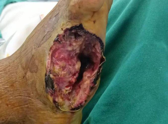 因糖尿病截肢!球爹:曾想放弃生命 是儿子们的鼓励让我坚持下来